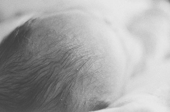 早產兒視網膜病變